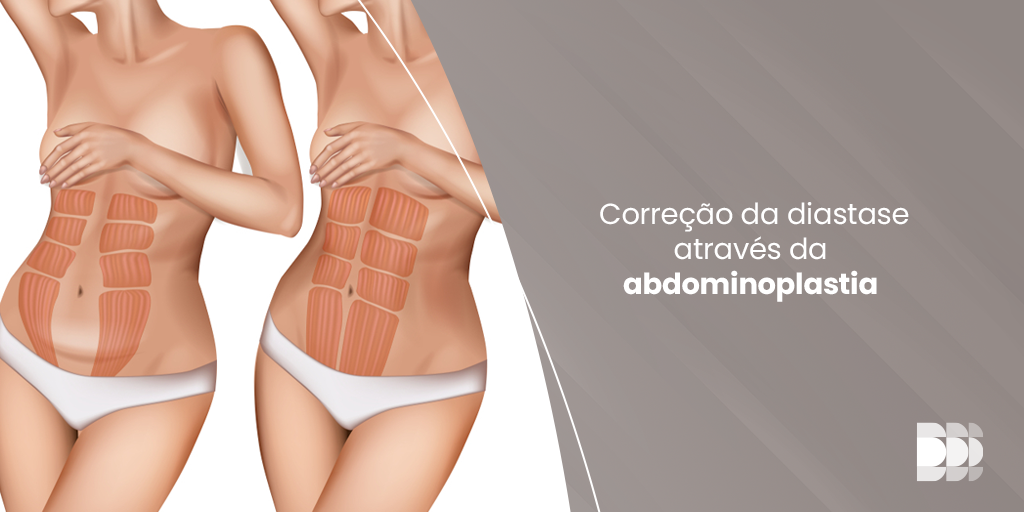 Leia mais sobre o artigo Correção da diastase através da abdominoplastia