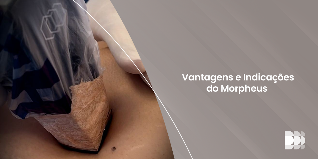 No momento, você está visualizando Vantagens e Indicações do Morpheus