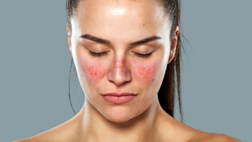 Avaliação de lúpus antes da colocação de silicone com o Dr. Paulo Henrique Laia