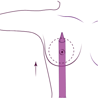 Ilustração da Técnica Preservé para Prótese de Silicone Natural.